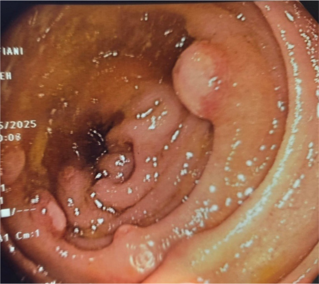 Delayed Presentation of Blind Loop Syndrome as Iron Deficiency Anaemia Following Ileo-Colonic Anastomosis: A Rare Postoperative Complication.