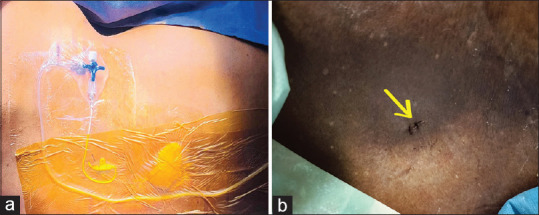 Management of Persistent Postoperative Cerebrospinal Fluid Leak Following Removal of Lumbar Spinal Drain After Thoracoabdominal Aortic Aneurysm Repair.
