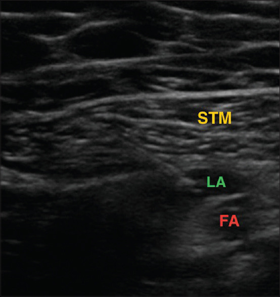 Comparative analysis of dual versus single subsartorial block for postoperative analgesia after total knee arthroplasty - A randomized, double-blind study.