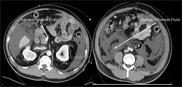 Refractory metabolic acidosis and acute abdominal compartment syndrome following Holmium Laser Enucleation of Prostate (HoLEP).