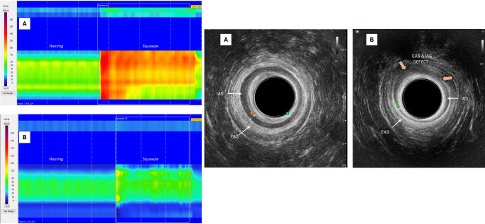 Postpartum Anorectal and Pelvic Floor Disorders: Evaluation, Treatment, and Prevention.