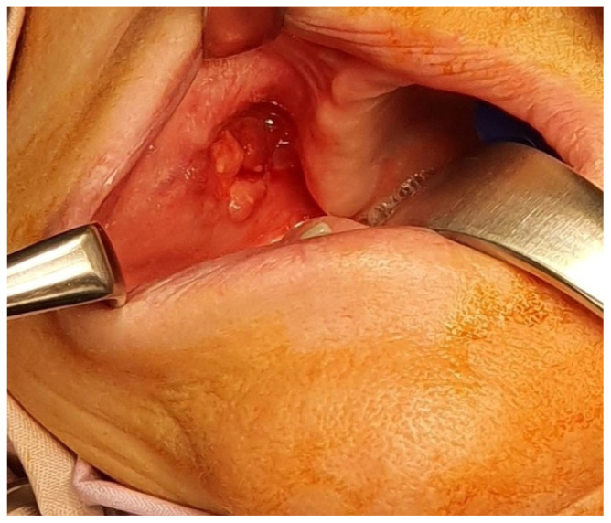 Polymorphous adenocarcinoma: a review of the literature and presentation of a case in an uncommon anatomical area.