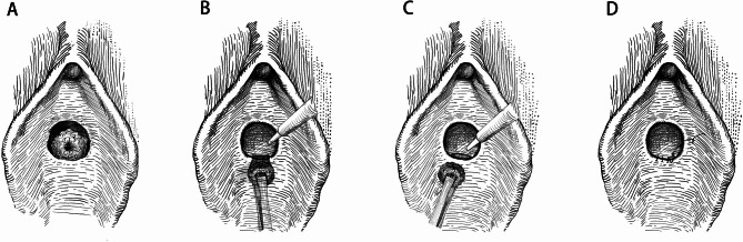 Resection of urethral caruncles with holmium laser vs. conventional excision: a comparative study of minimally invasive outcomes.