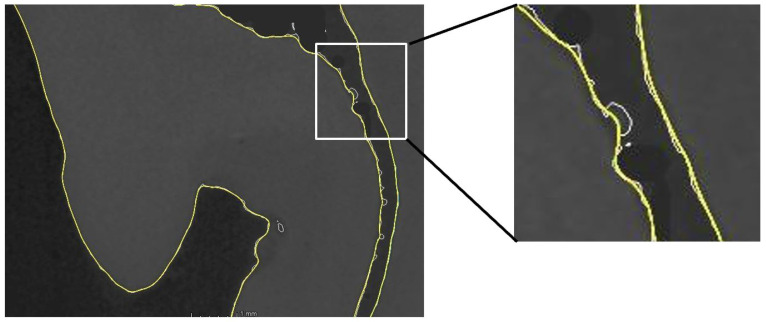 The Integration of Micro-CT Imaging and Finite Element Simulations for Modelling Tooth-Inlay Systems for Mechanical Stress Analysis: A Preliminary Study.