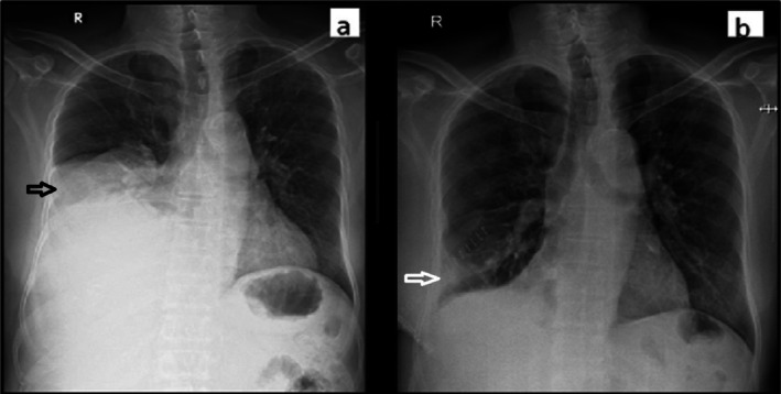 Paraneoplastic Hypoglycaemia in a Patient With Solitary Fibrous Tumor of Pleura.