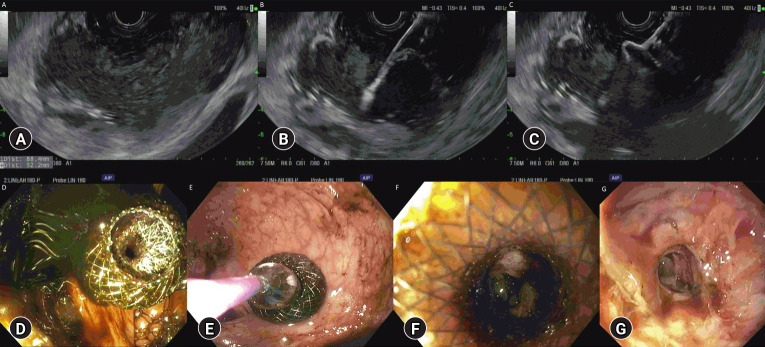 Endoscopic ultrasound-guided transrectal drainage of deep pelvic abscesses is safe and effective in children.