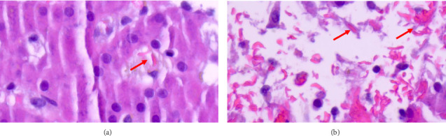 Secondary Dengue Infection Complicated by Hemophagocytic Lymphohistiocytosis: A Case Report.