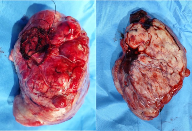 Paraneoplastic Hypoglycaemia in a Patient With Solitary Fibrous Tumor of Pleura.