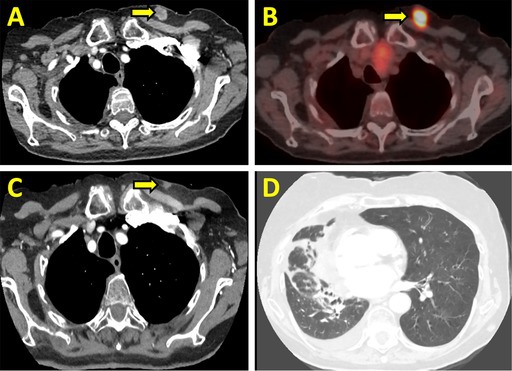 Primary Pulmonary Leiomyosarcoma: A Case of Prolonged Survival With Radiotherapy and Pazopanib in a 90-Year-Old Female.