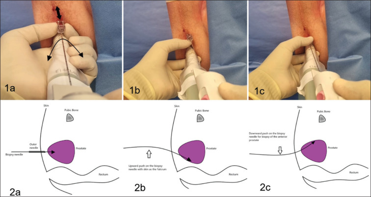 Diagnostic precision, safety, and patient experience of the freehand transperineal prostate biopsy technique under local anesthesia - A single-center experience.