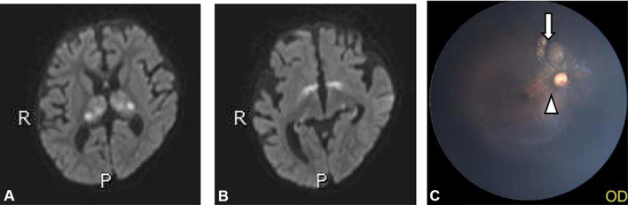Microstructural injury to the optic nerve with vigabatrin treatment in West syndrome: A DTI study.