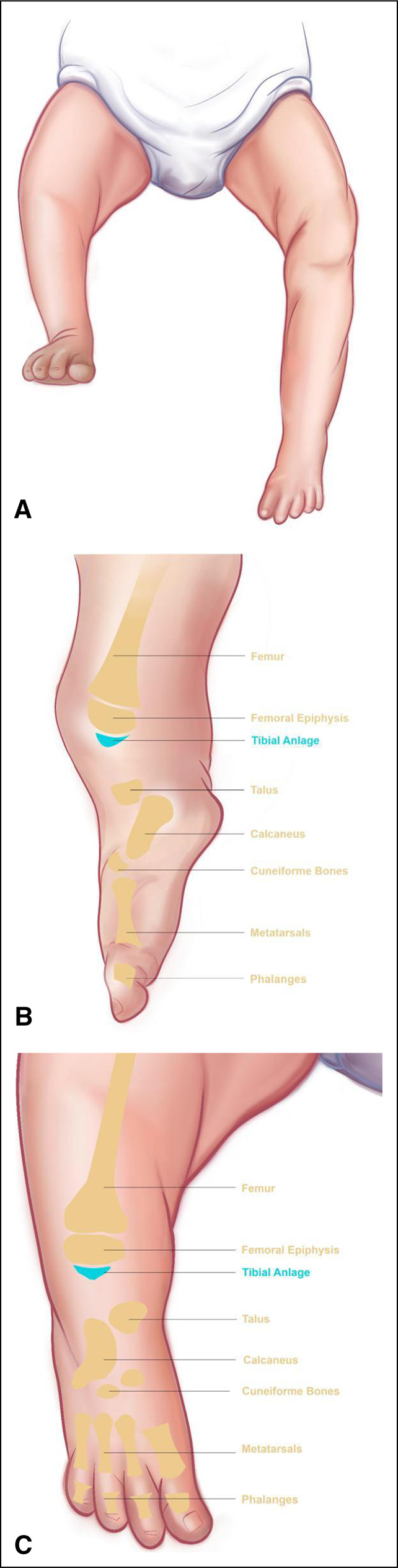 New Reconstruction Technique in Combined Tibial and Fibular Hemimelia.