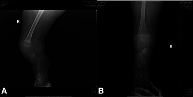 New Reconstruction Technique in Combined Tibial and Fibular Hemimelia.