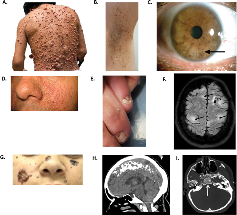 A diagnostic approach to neurocutaneous syndromes.