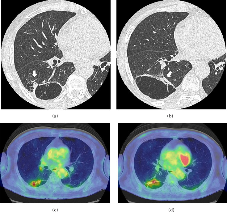 Small-Cell Lung Carcinoma Associated With Cystic Airspaces: A Case Report.