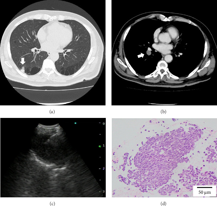 Small-Cell Lung Carcinoma Associated With Cystic Airspaces: A Case Report.