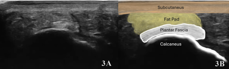 Diagnostic Musculoskeletal Ultrasound in the Evaluation of the Plantar Fascia.