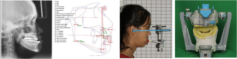 Comparison of accuracy of maxilla between virtual surgical planning and conventional surgical planning in bimaxillary orthognathic surgery: a randomized controlled trial.