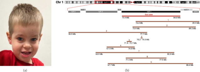 Chromosome 1p31.1 Deletion: A Case With Developmental Delay, Hypotonia, Cryptorchidism, Abnormal Oral Frenulum, and Feet Deformity.