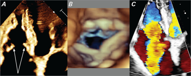 Complex Tricuspid and Pulmonic Carcinoid Heart Disease With Timely Surgical Repair.