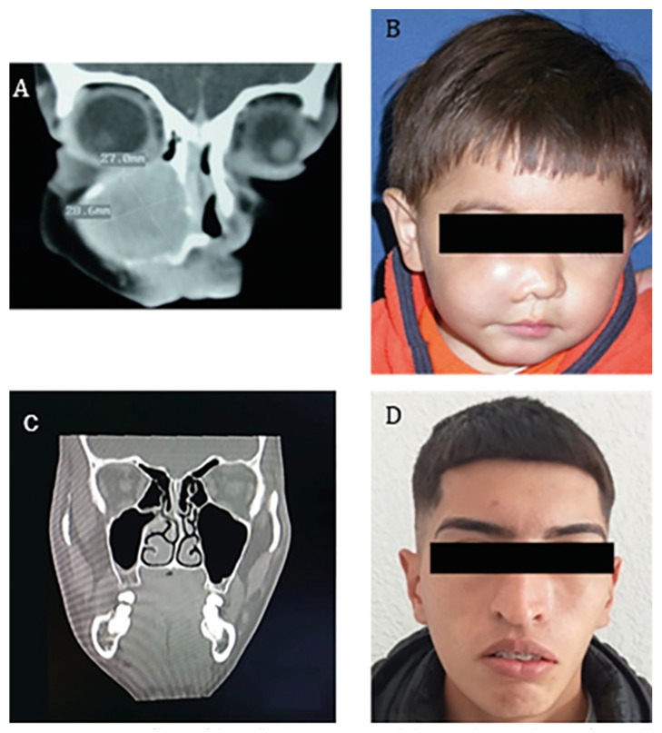 Myofibromas of the jawbones in pediatric patients. A clinicopathological study.