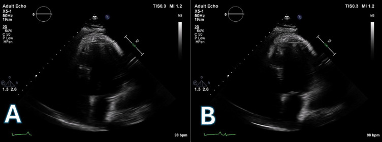 A Traumatic and Infected Left Ventricular Pseudoaneurysm 2 years After the Explantation of a Bridge-to-Recovery Left Ventricular Assist Device.