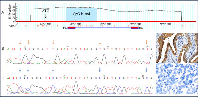 Methylated ARHGAP40 DNA as a potential biomarker for early diagnosis in high-grade ovarian serous cancer.