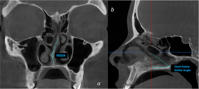 Evaluation of a rare known anatomic formation: Parinaud's canal.
