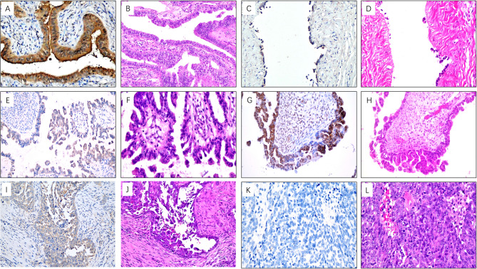 Methylated ARHGAP40 DNA as a potential biomarker for early diagnosis in high-grade ovarian serous cancer.
