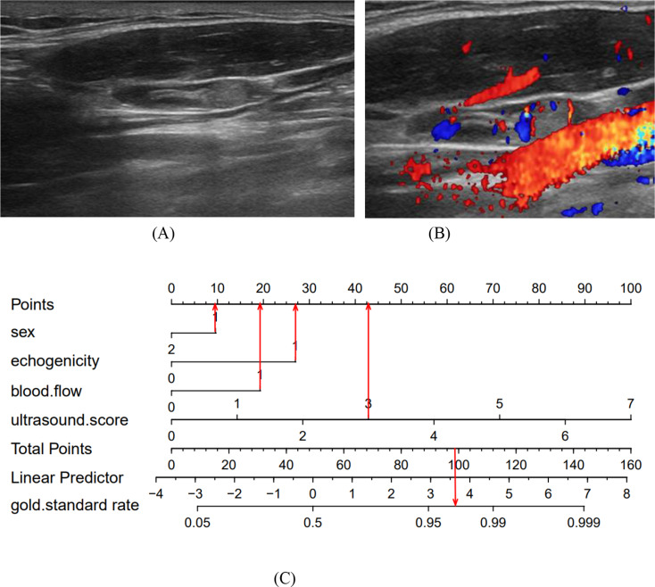 The value of ultrasonographic scoring method and nomogram in assessing cervical lymph node metastasis of papillary thyroid carcinoma.