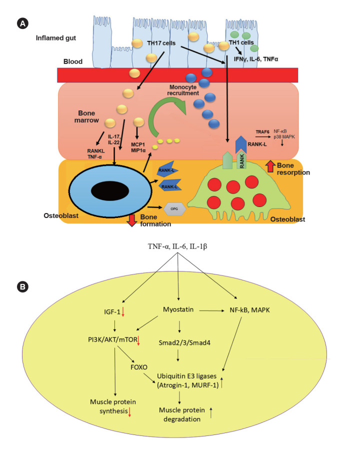 Gut, bone, and muscle: the triad of osteosarcopenia in inflammatory bowel disease.