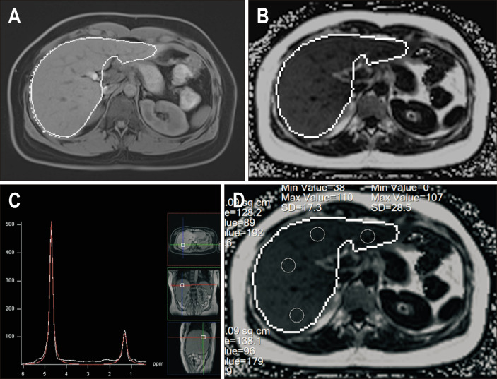 Automated Whole-Liver Fat Quantification with Magnetic Resonance Imaging-Derived Proton Density Fat Fraction Map: A Prospective Study in Taiwan.