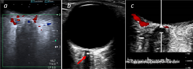 Retinal ischemia due to different stages of atherosclerosis - insights from a retrospective study on central retinal artery occlusion.