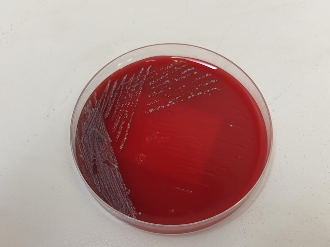 Infection Leading to Breast Abscess Formation in Pregnancy: A Case Report.