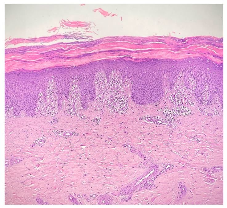 Efficacy of Dupilumab in a Young Woman with Refractory Cutaneous Lichen Planus: A Case-Based Review.