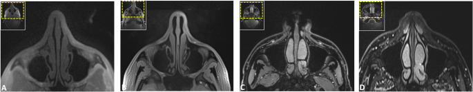 Black bone and CT-like MRI-based delineation of fracture-prone regions in oral and maxillofacial trauma.