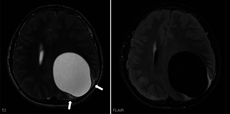 A Rare Presentation of a Hydatid Cyst in the Brain.