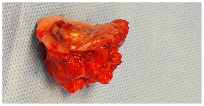 Polymorphous adenocarcinoma: a review of the literature and presentation of a case in an uncommon anatomical area.