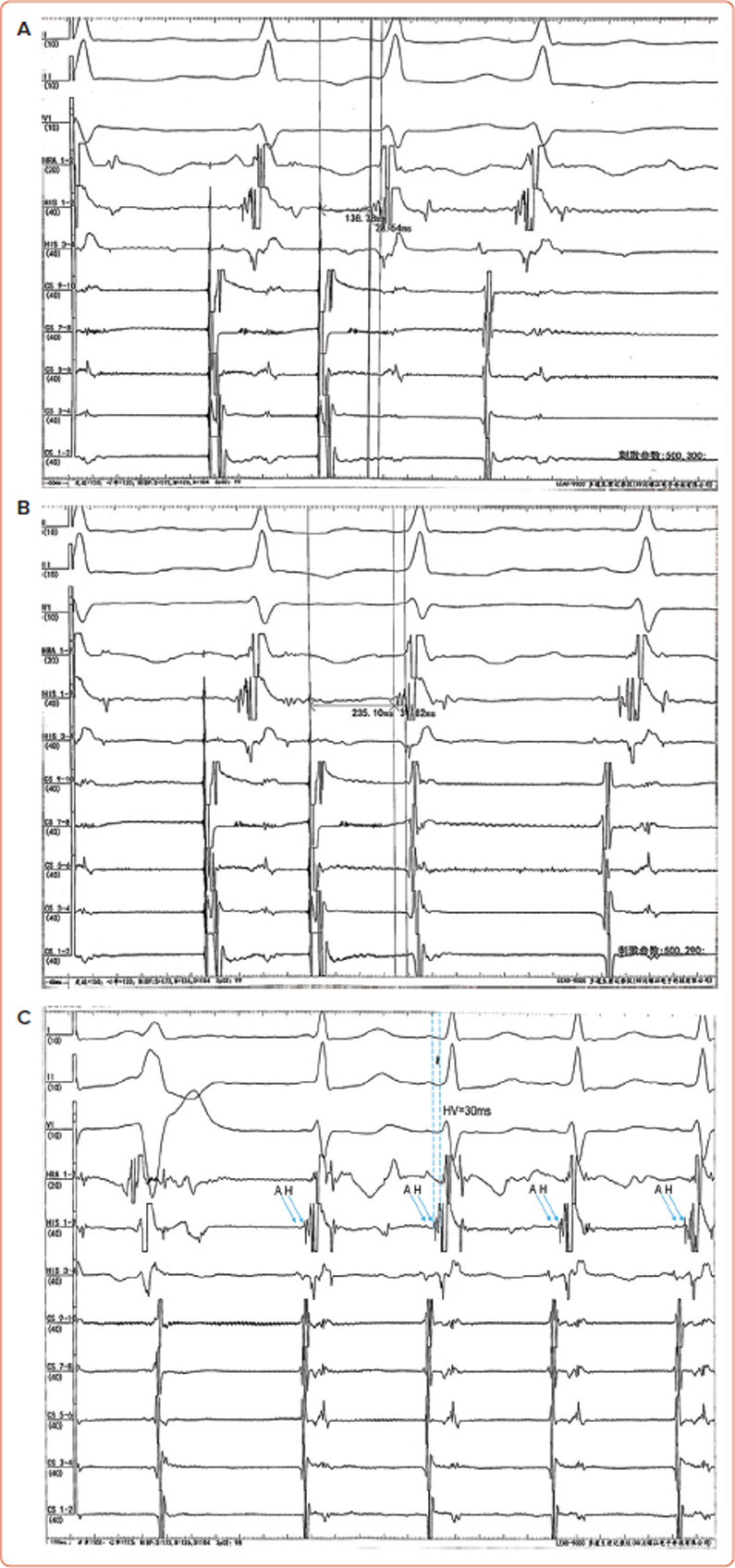 A Fasciculoventricular Accessory Pathway Featuring Functional Decremental Conduction and QRS Variability.