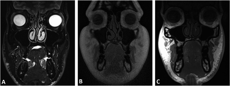 Black bone and CT-like MRI-based delineation of fracture-prone regions in oral and maxillofacial trauma.