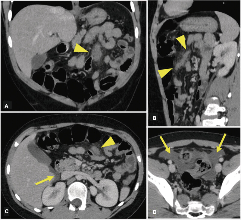 Mesenteric Shearing in a Pediatric Patient, Successfully Managed Conservatively: A Case Report.