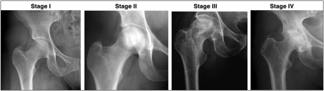 Clinical and Radiological Severity of Avascular Necrosis of the Femoral Head in Sickle Cell Disease Patients.