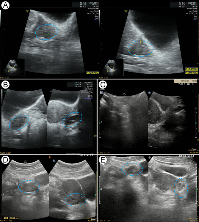 Successful treatment of Heyan Kuntai capsule combined with hormonal therapy in an adolescent with diminished ovarian reserve: a case report.