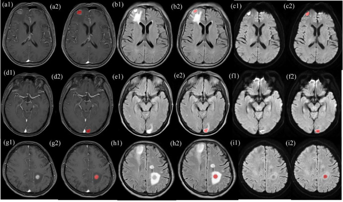 Identification of the pathological subtypes of lung cancer brain metastases with multiparametric MRI radiomics: A feasibility study.