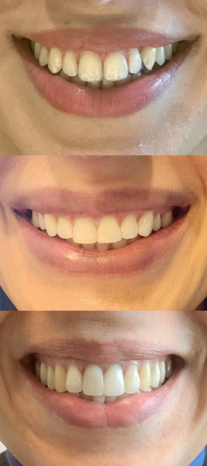 Impact of fixed orthodontic treatment with and without premolar extraction on gingival display index in men and women.