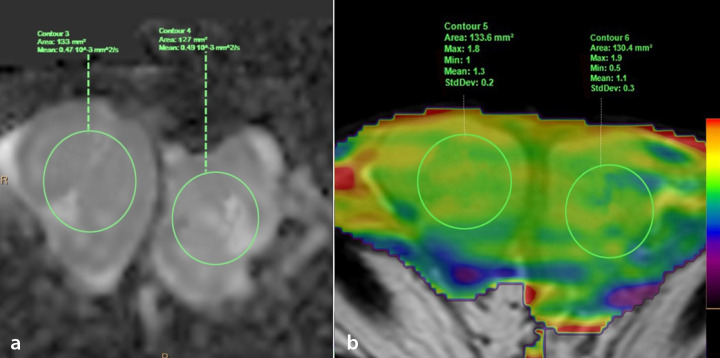 Amide proton transfer-weighted magnetic resonance imaging for the evaluation of testicular spermatogenic function: a preliminary study.