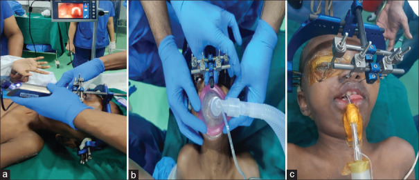 Airway management of a Crouzon syndromic child with mid face distractor in situ for redo osteotomy.