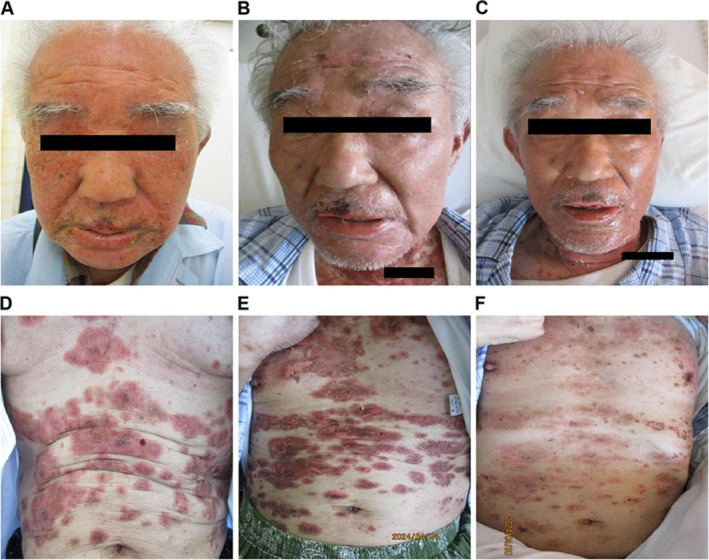 A Case of Stevens-Johnson Syndrome Triggered by Methicillin-Resistant <i>Staphylococcus aureus</i> Infection During Pembrolizumab Treatment for Lung Squamous Cell Carcinoma.
