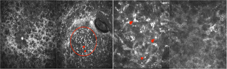 Retinal and choroidal detachment following corneal wasp sting: a case report and literature review.
