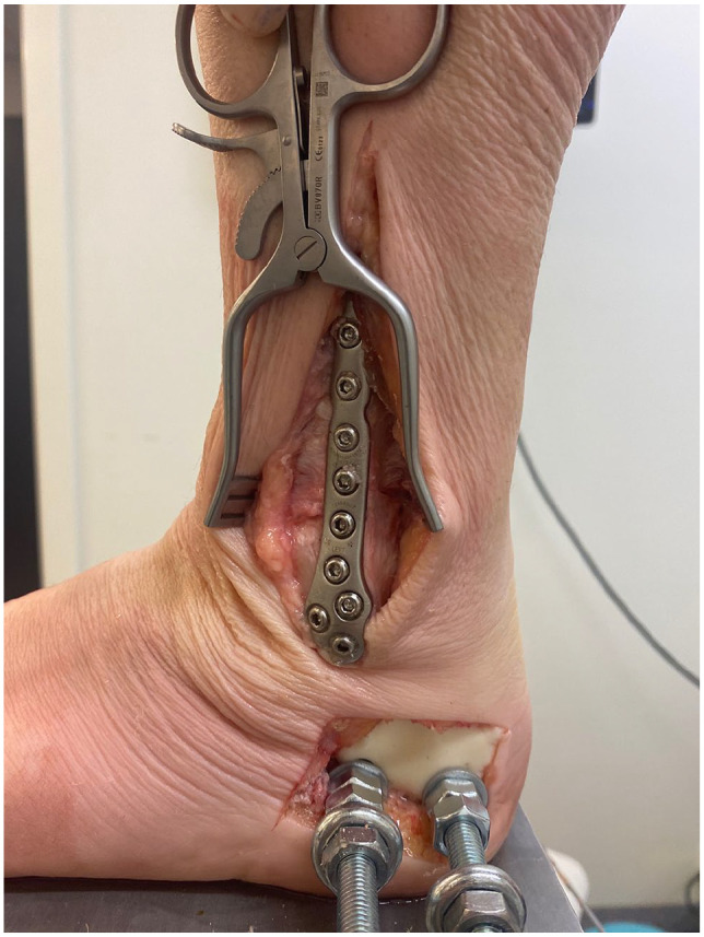 Effects of Fibular Plate Fixation and Deep Posterior Tibiotalar Ligament Repair on Ankle Stability in a Weber B Fracture Model with Complete Deltoid Ligament Sectioning.